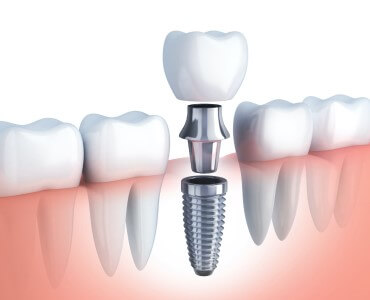 tratamiento implantes dentales