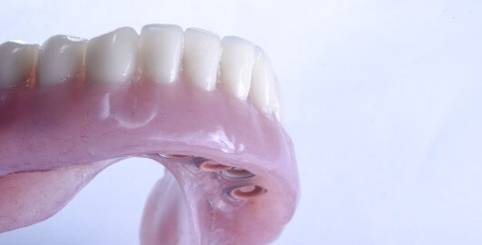 que es un implante dental