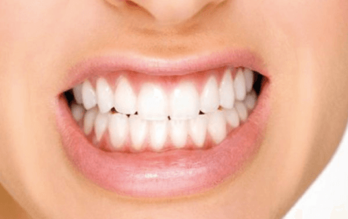 Carillas dentales