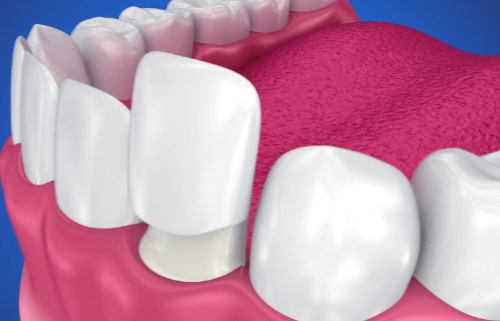 Coronas dentales