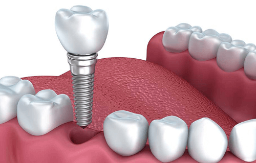 Implante dental carga inmediata
