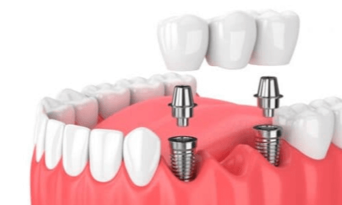 Implante dental de carga inmediata