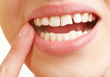 Injerto de hueso dental
