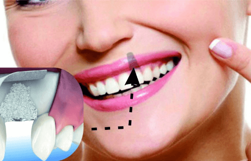 Injerto de hueso dental