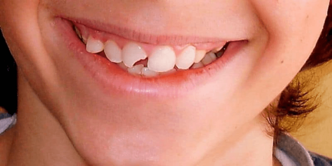 diente roto