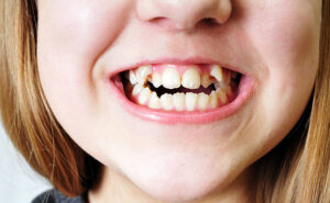 ortodoncia invisible para apiñamiento dental 