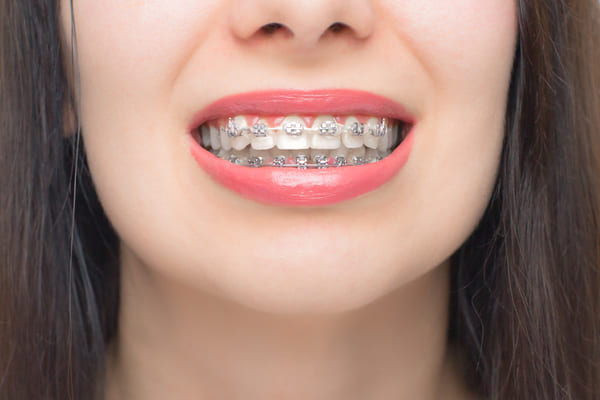 ¿Qué tipo de dientes necesitan ortodoncia con brackets?