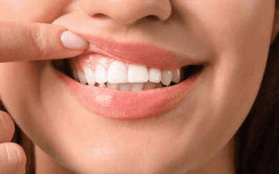 Causas, síntomas y tratamiento de las encías blancas