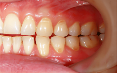 Tipos de manchas en los dientes