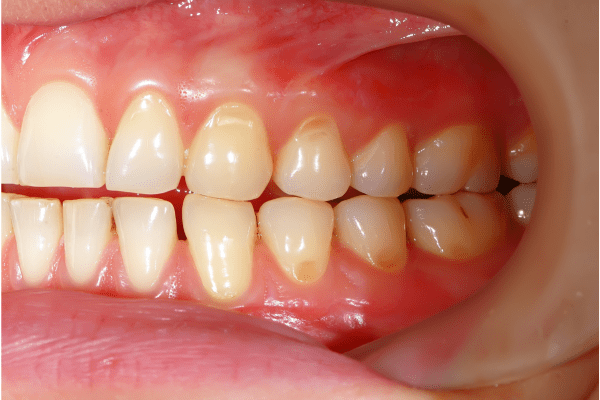Manchas en los dientes