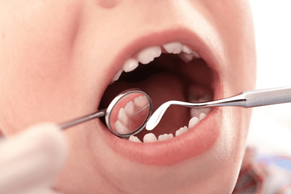 Agenesia dental: qué es y tratamiento