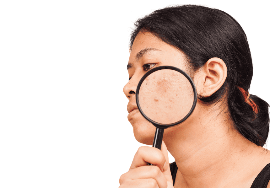 Eliminar manchas y marcas faciales