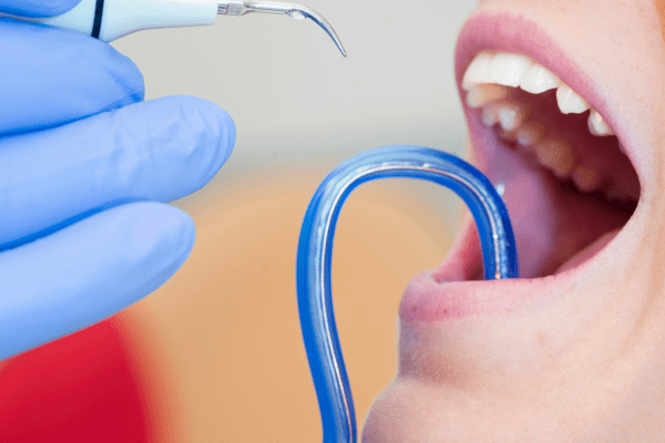 Cómo eliminar el sarro duro detrás de los dientes