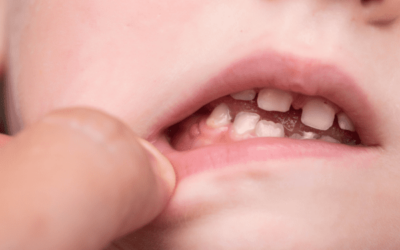 Épulis dental, ¿cómo se trata y de qué forma se puede evitar?