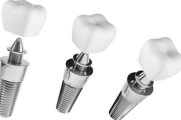 Diferencias entre los implantes dentales All on Four y All on Six