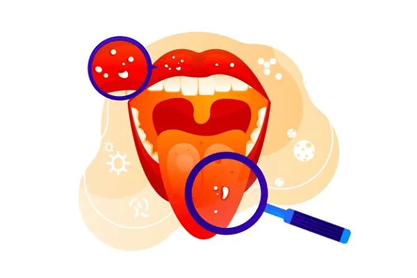 8 enfermedades de la lengua más comunes Causas y soluciones