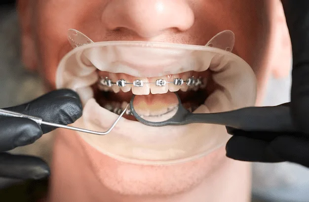 Aparato Herbst en ortodoncia Para qué sirve y cuándo se emplea