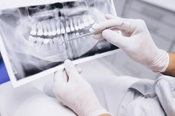 Bolsas periodontales qué son
