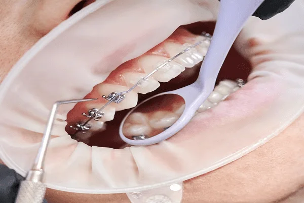La ortodoncia y cómo corregir la posición de los dientes