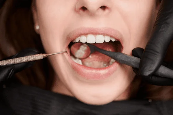 Qué es y cuándo se hace una incrustación dental