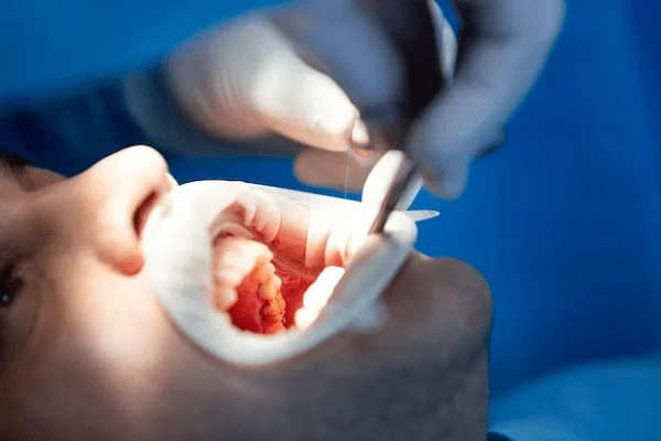Recorte de encías o gingivectomía