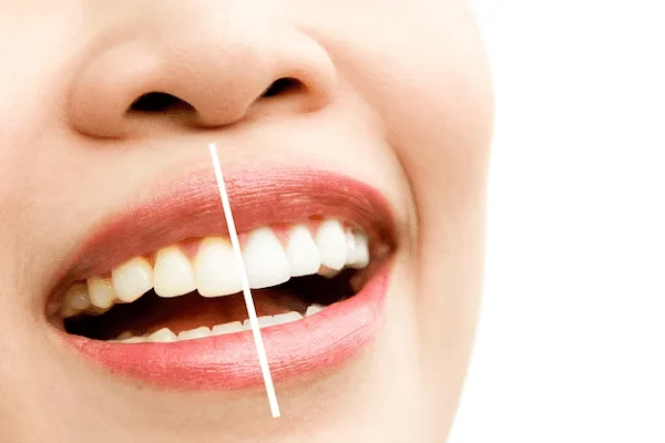 Tipos de blanqueamientos dentales