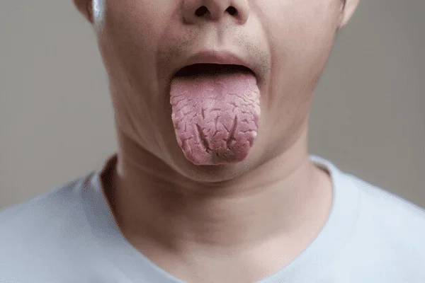 Tratamiento de lengua agrietada o escrotal