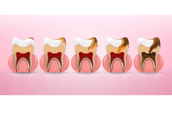 Tipo de Carie Dental