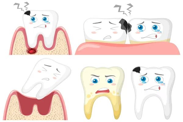 Tipos de Caries Dentales