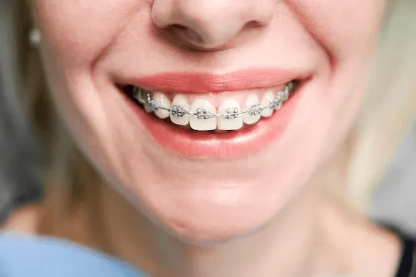 Fases o etapas de la ortodoncia