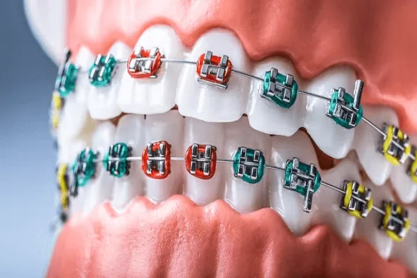 Fases o etapas de la ortodoncia