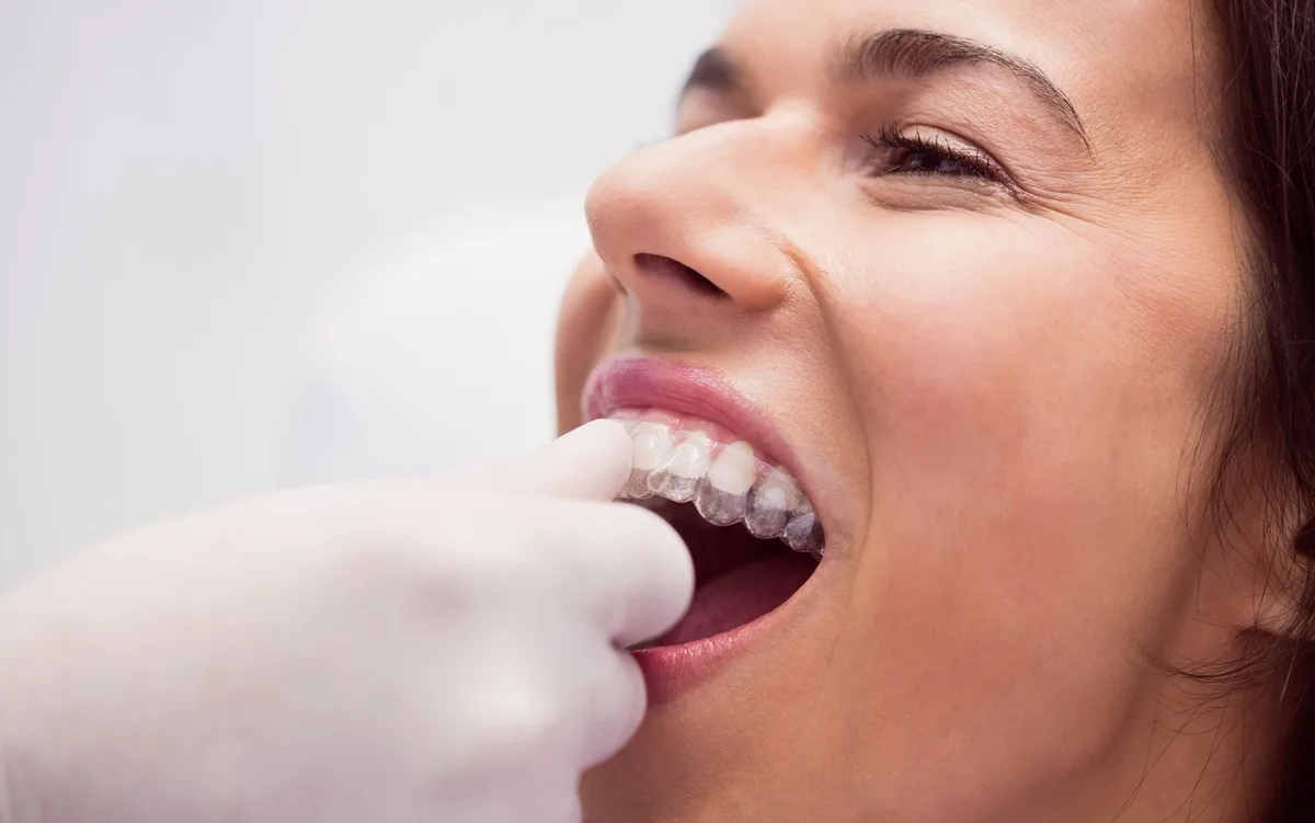¿Cómo funciona la ortodoncia Spark?