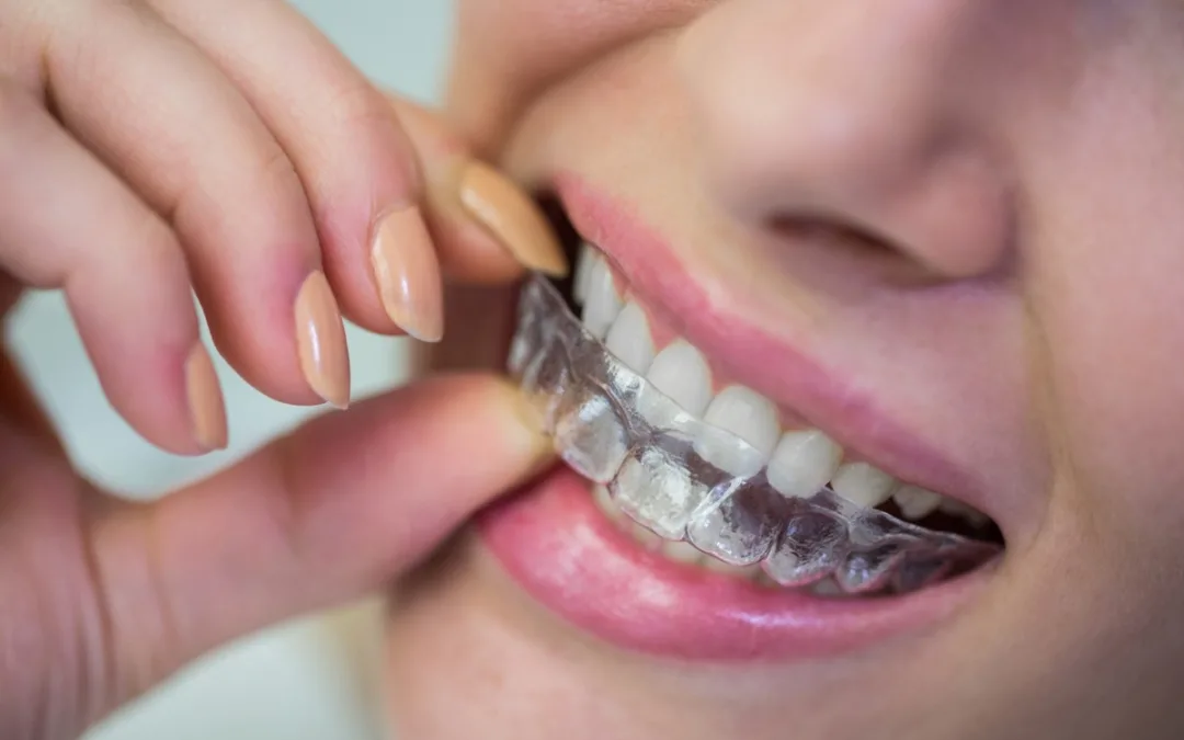Invisalign: dudas más comunes y su respuesta
