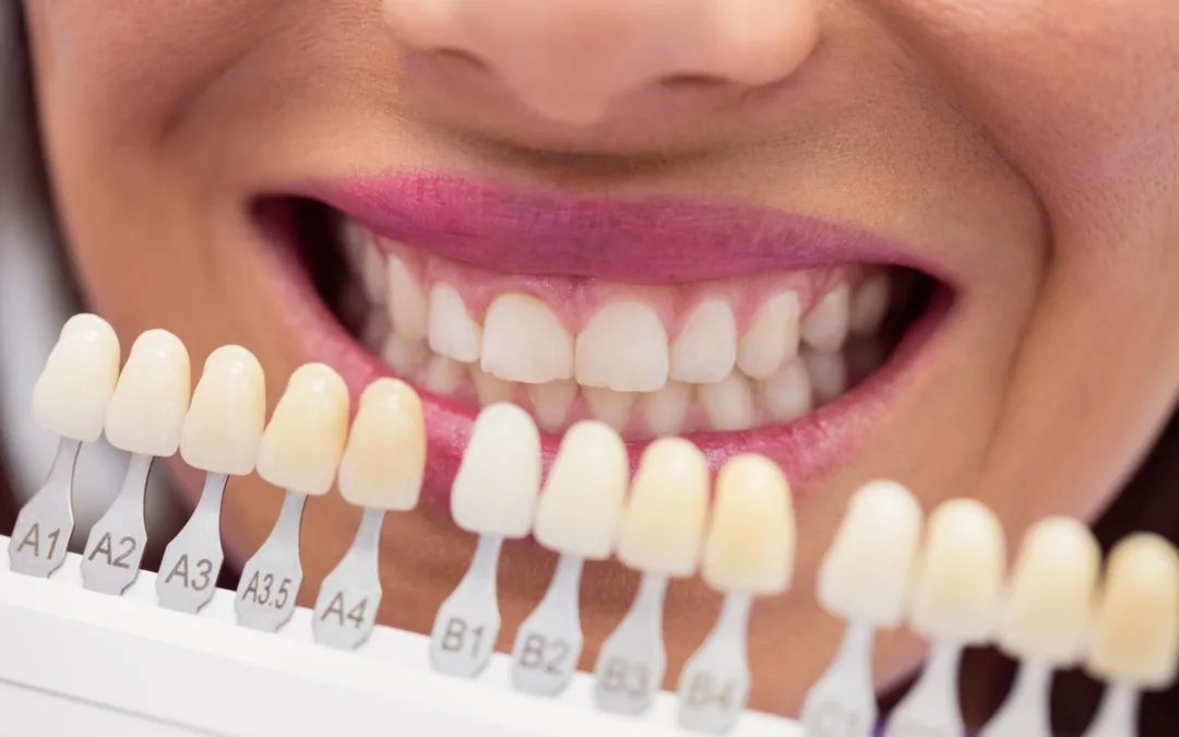 ¿Son recomendables las carillas de zirconio?