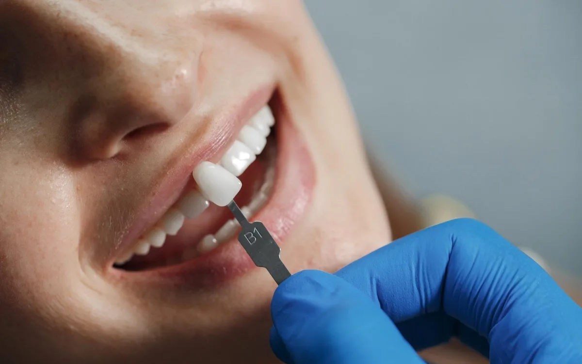 ¿Qué es la funda de un diente?