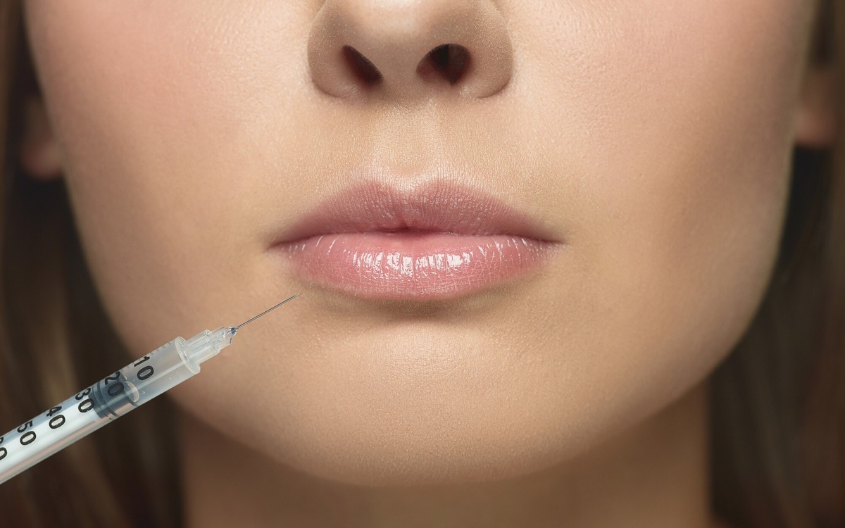 ¿Cuánto tiempo duran los labios con ácido hialurónico?