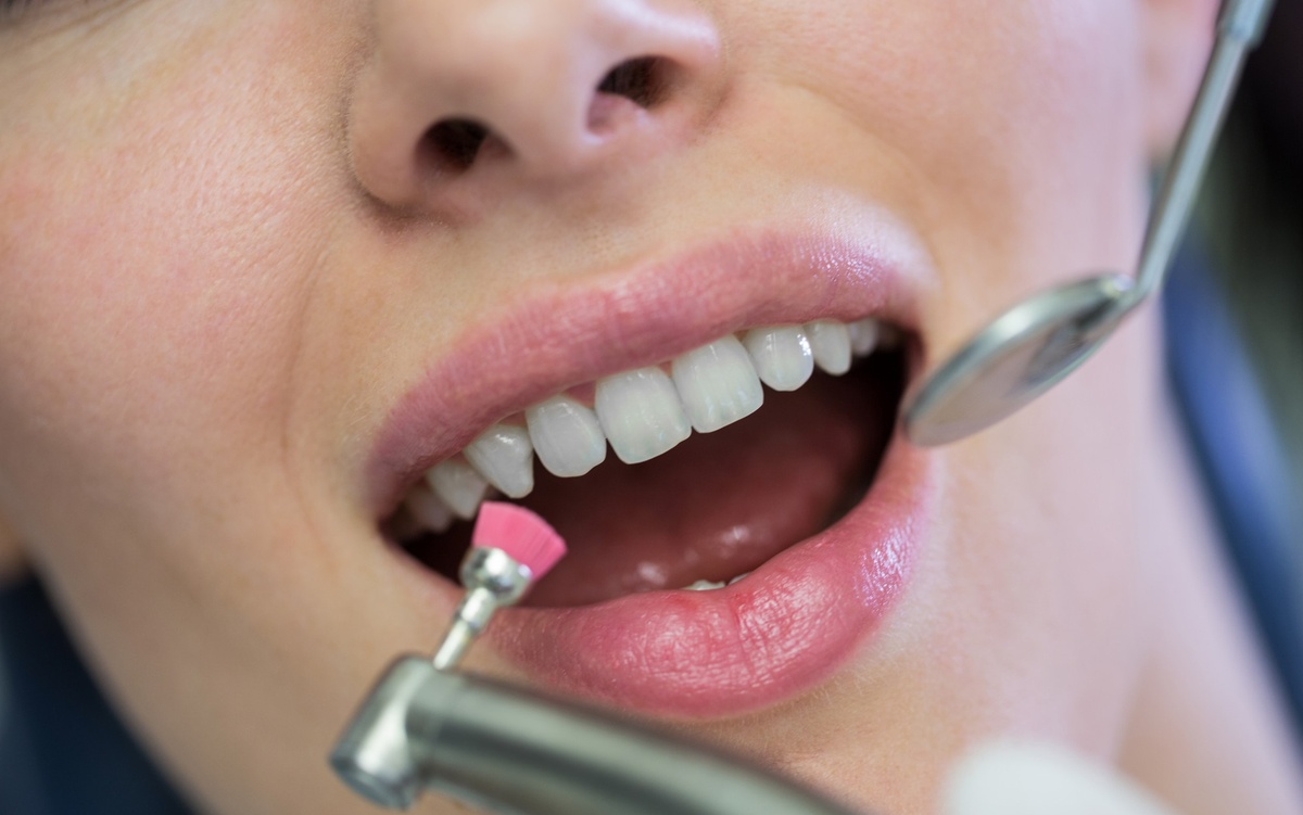 Ferulización periodontal
