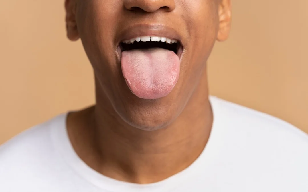 ¿Qué es glositis?: Síntomas, causas y tratamiento
