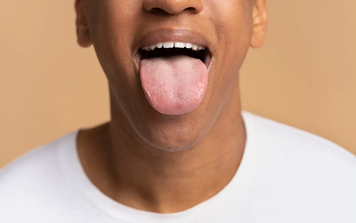 Cómo curar heridas en la lengua