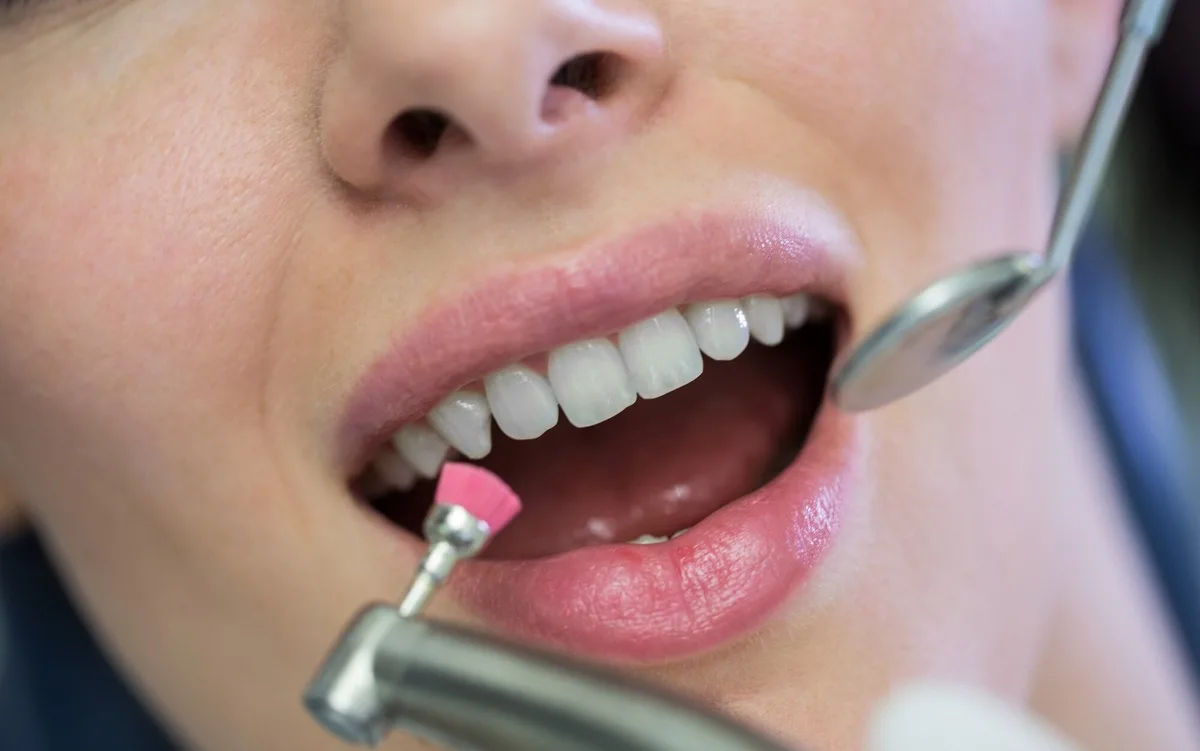 ¿Qué diferencia hay entre el curetaje y la limpieza dental?