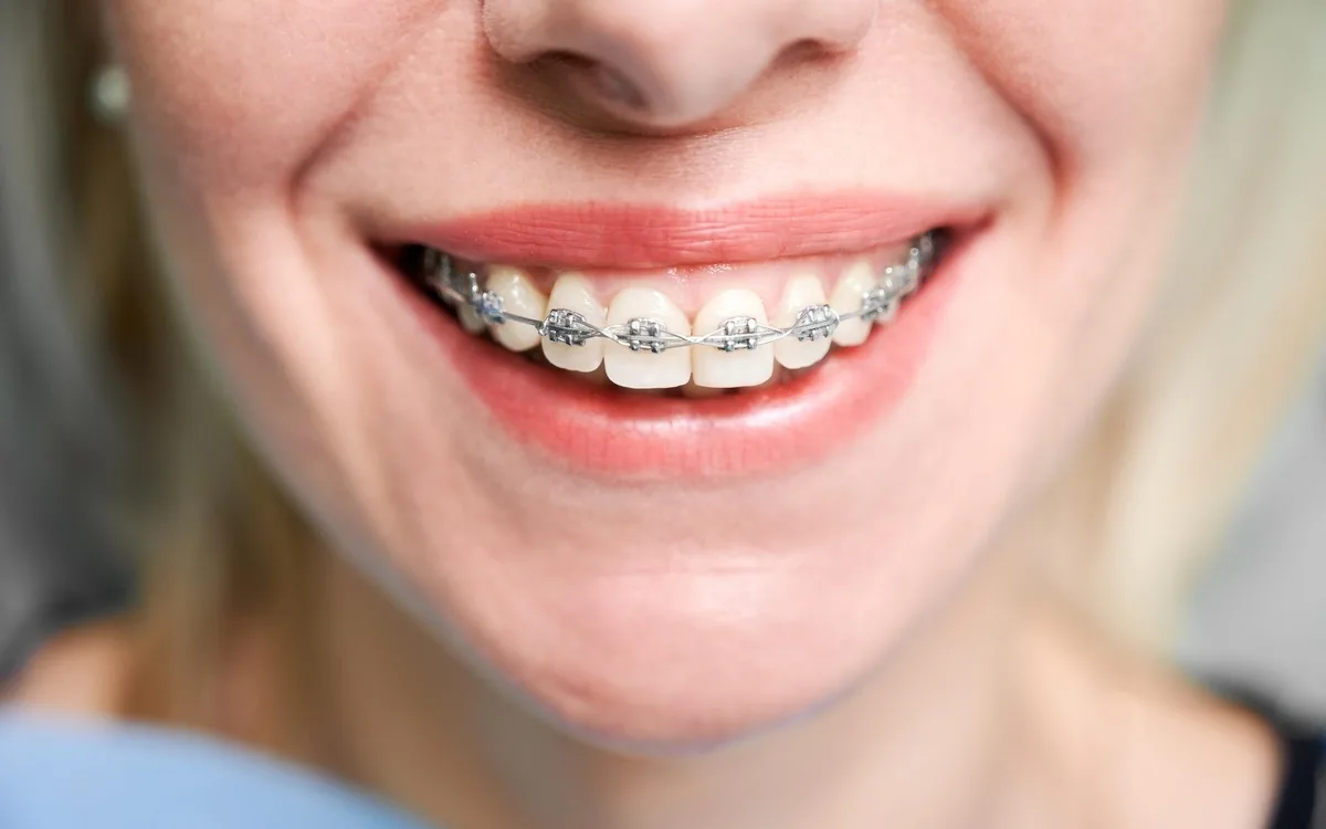 ¿Cuándo se debe realizar la ortodoncia?