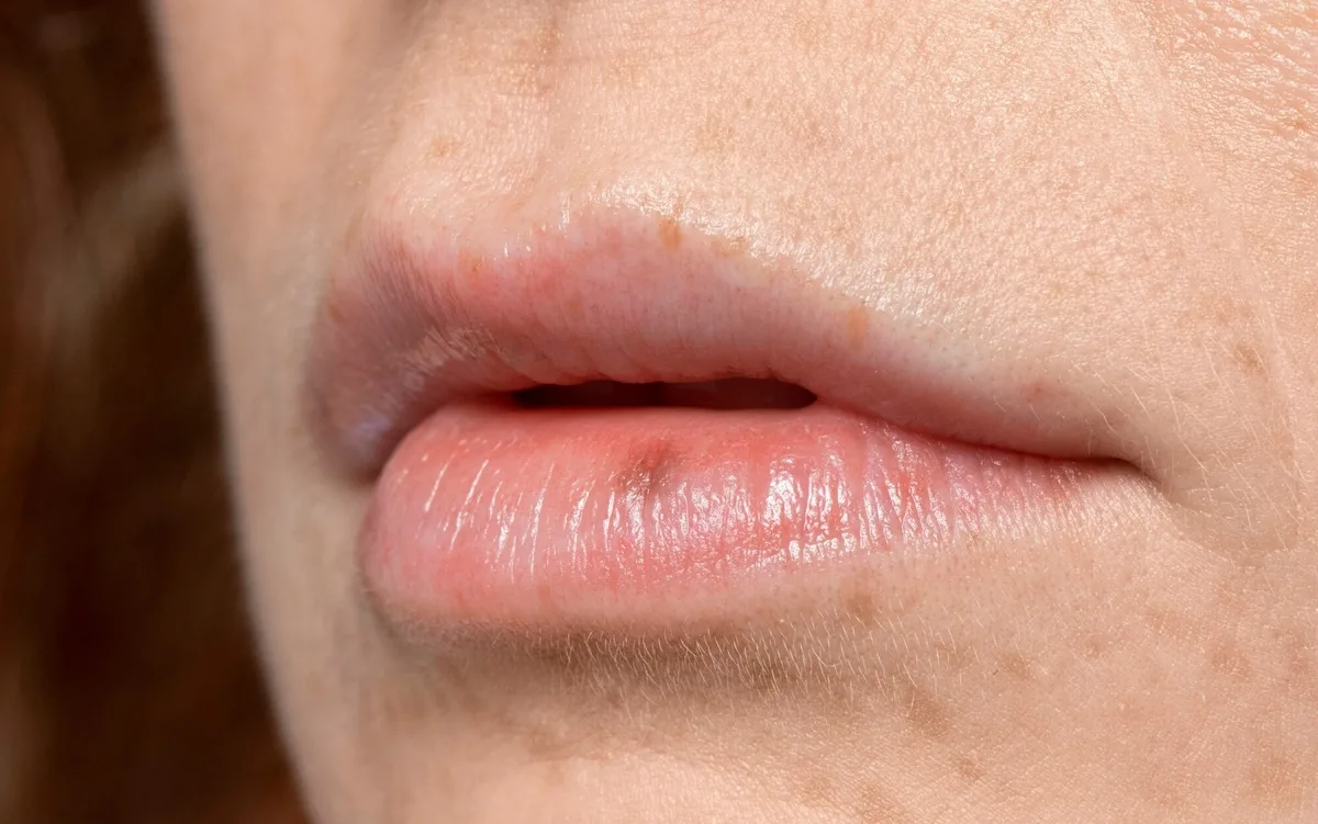 ¿Qué enfermedad causa la resequedad de los labios?