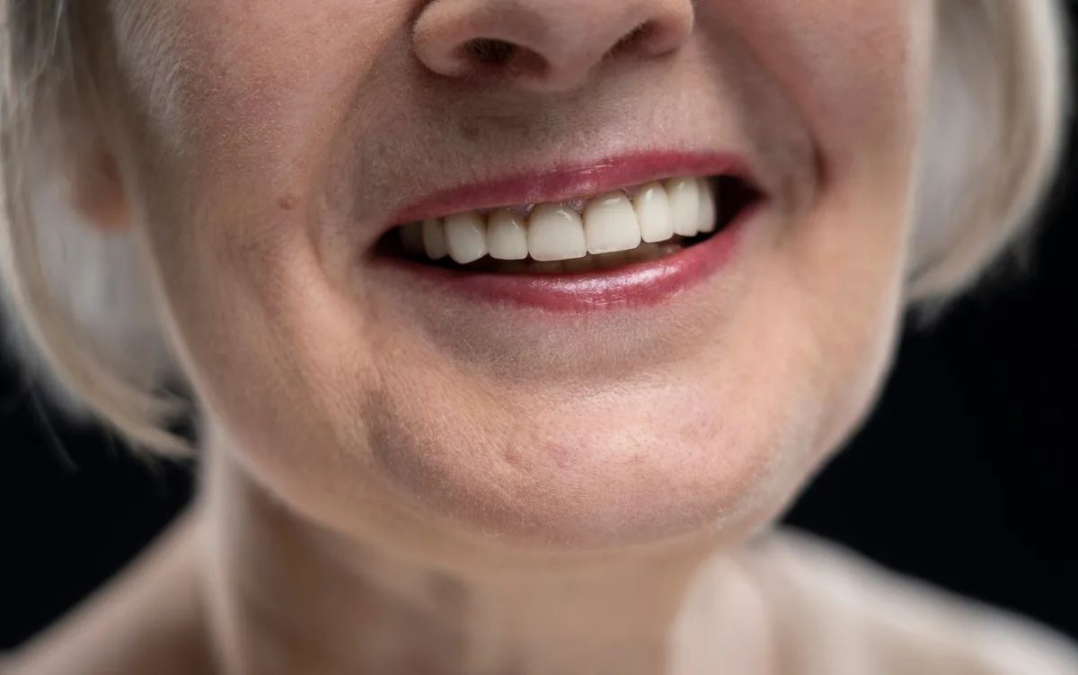 ¿Cómo quedan los dientes después de los brackets?
